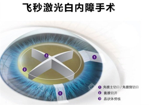 惠州白内障手术价格表大全，超声乳化手术5000元起/飞秒激光辅助白内障手术10000元起！