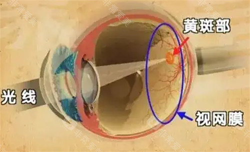 黄斑眼病的发病位置图解