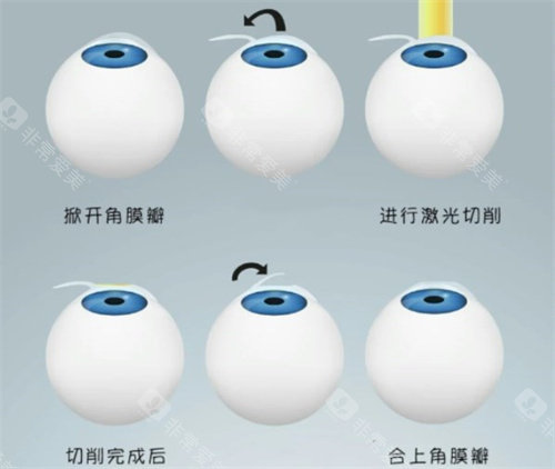 半飞秒手术过程