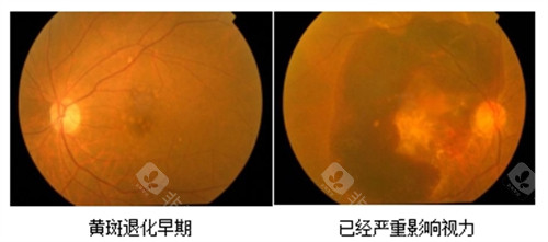 黄斑病变早期和重度