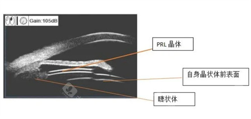 PRL晶体植入术原理
