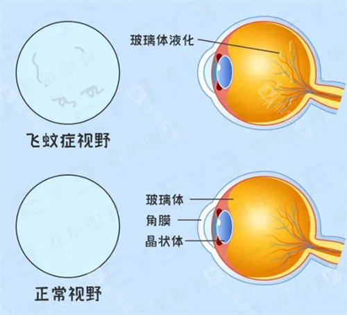 飞蚊症示意图