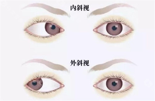 湛江斜视手术价格表查询，轻度斜视3503元起/中度斜视6285元起！