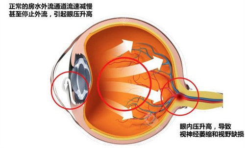 青光眼激光手术能维持多久?适应人群与手术效果全面解读