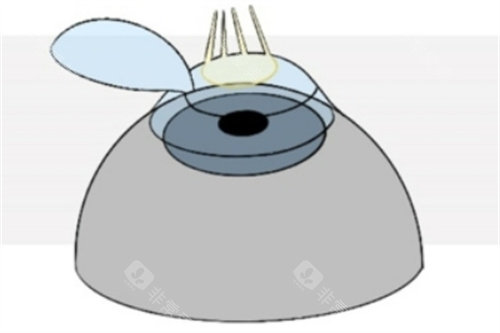 Refractive-Surgery-Techniques-1024x493_副本1