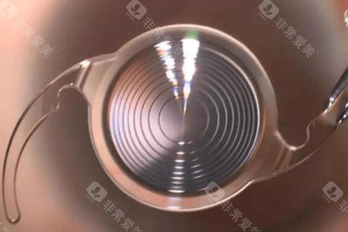 爱尔眼科医院白内障手术价格：超声乳化5000元起，飞秒激光15000元起