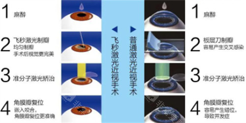 飞秒近视手术与激光近视手术的过程区别图解