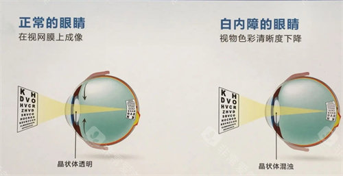 白内障的眼睛示意图