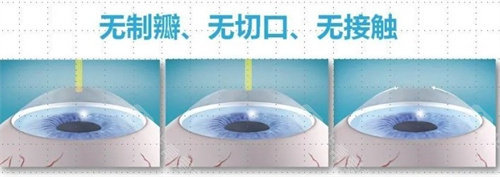 飞秒近视手术