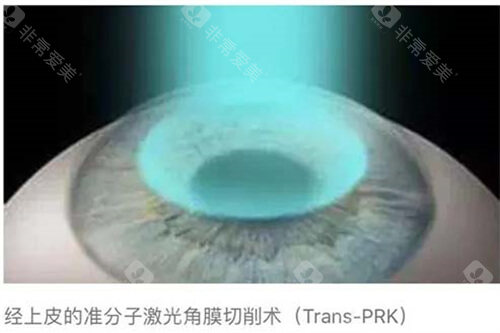 近视眼手术10