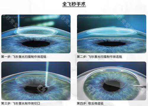 近视眼手术4