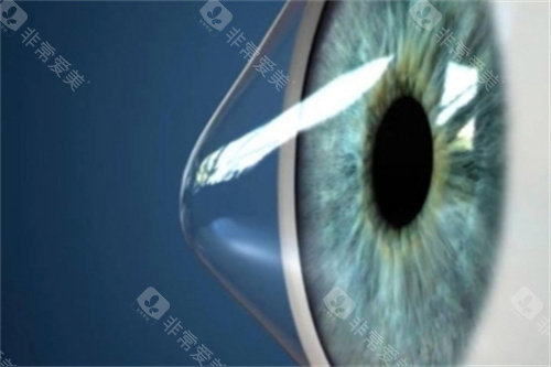 爱尔眼科圆锥角膜手术2025价目表17600元起/单眼,揭秘爱尔眼科圆锥角膜交联手术多少钱!