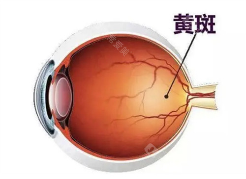 黄斑眼病的样子图解