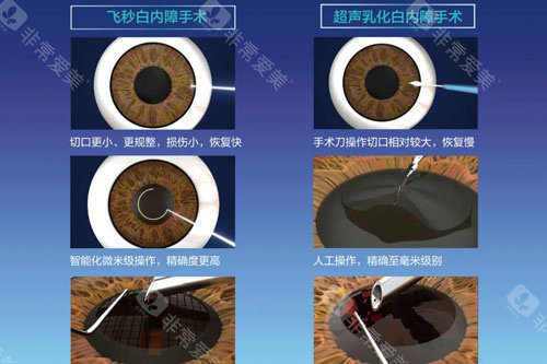 飞秒白内障和超声乳化白内障