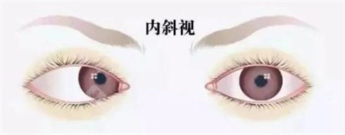 斜视
