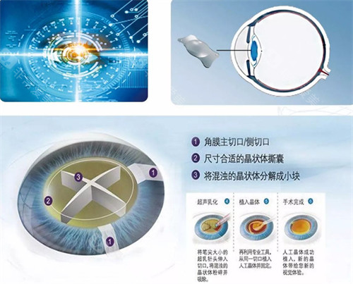 阳江白内障手术价格表查询，传统白内障手术5600起/飞秒激光白内障手术13098起！