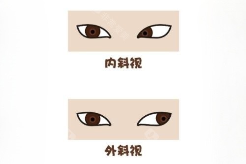 西安斜视矫正手术一般多少钱？佰视佳眼科/存济眼科/普瑞眼科收费标准均可查！