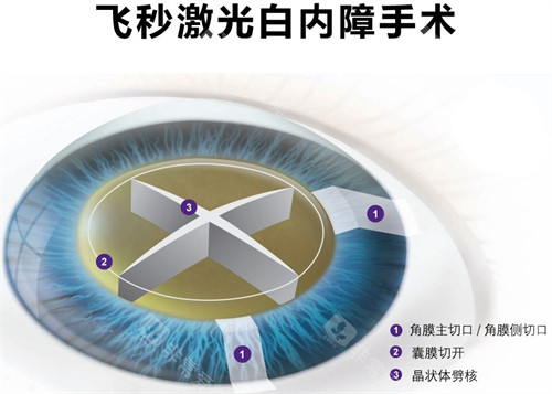 飞秒白内障手术细节图