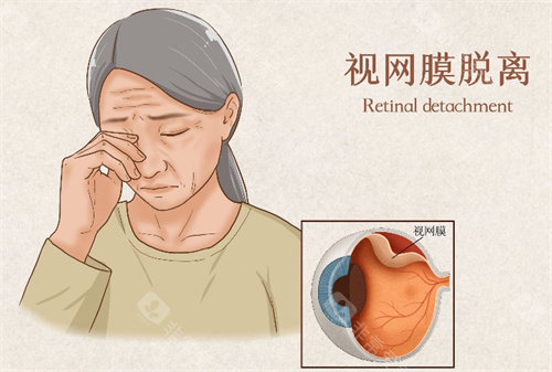 视网膜脱落的症状