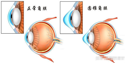 正常角膜与圆锥角膜对比图