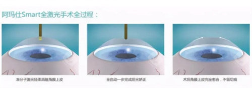 阿玛仕全激光手术全过程