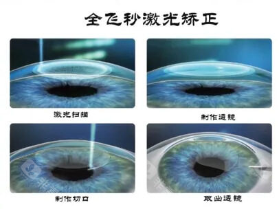 近视眼手术3
