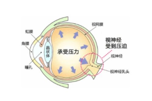 眼睛眼压高概念图