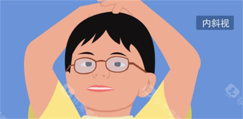 45岁斜视眼睛还能做矫正手术吗？医师为您多方面解析！