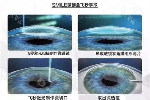 徐州市第一人民医院近视眼手术价格明细，全飞秒、半飞秒、晶体植入价格参考