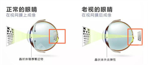 老花眼