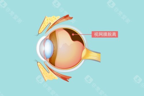 视网膜脱落图片展示