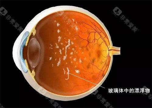 玻璃体混浊