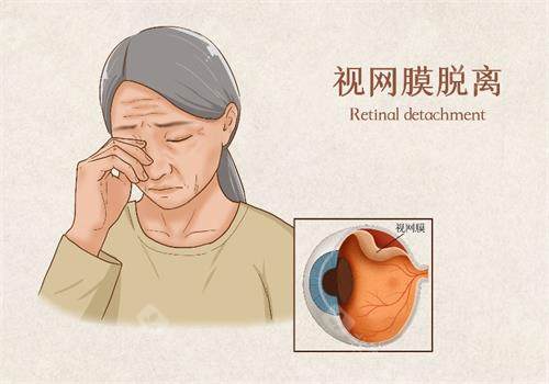 视网膜脱落示意图