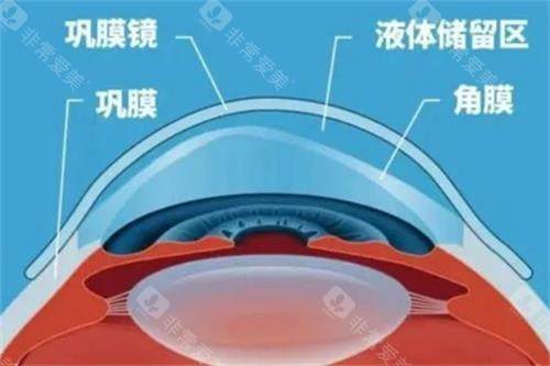 巩膜镜结构图