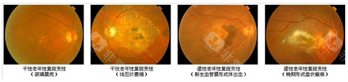 黄斑病变不同的表现