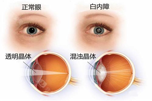 老年人做白内障有哪些免费政策？2025年政策有变化这篇文章一眼看懂！
