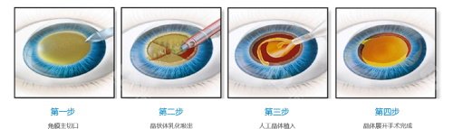 单焦晶体和多焦晶体8