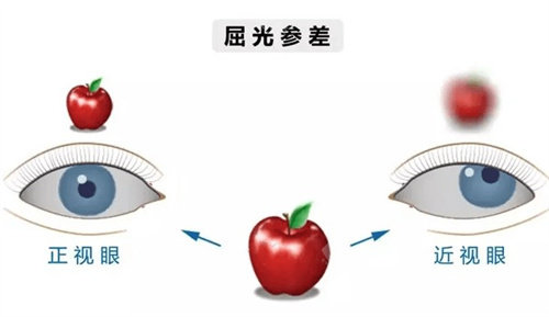 昆明艾维眼科看近视好吗？手术技术成果与优势口碑全知晓