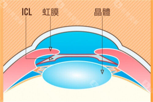 ICL示意图