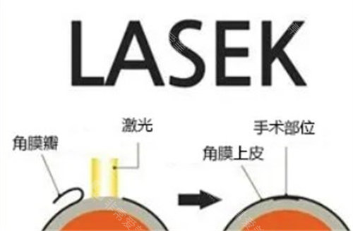 LASEK手术