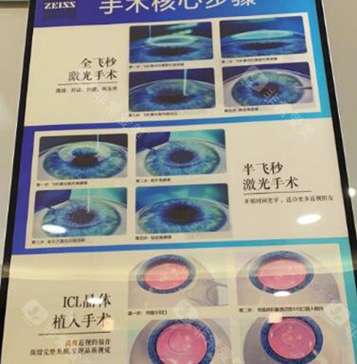 重庆佰视佳眼科做近视眼手术怎么样？佰视佳是做视力矫正的专科医院口碑好的狠！