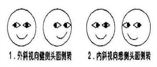 斜视自测图