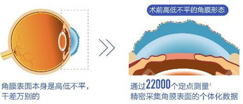 宁波华厦眼科近视手术价格表查看，准分子激光9800元起/半飞秒11800元起/ICL晶体植入28000元起！