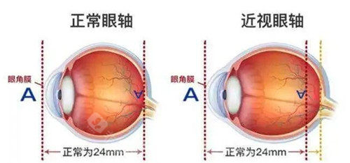 近视眼轴长度图片