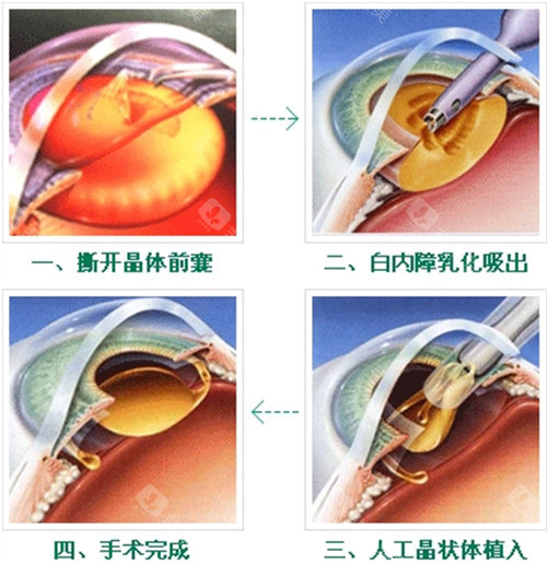 重庆老年人白内障免费治疗吗？政策详情与申请指南来了！