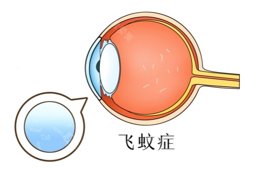 飞蚊症图片展示