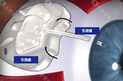青光眼引流阀