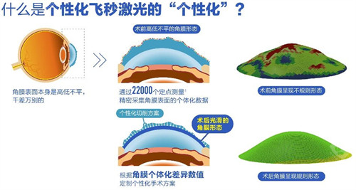 巴音郭楞蒙古自治州看近视多少钱？2025巴音郭楞蒙古自治州近视手术价格表