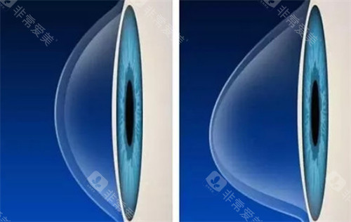 圆锥角膜和正常角膜的不同之处