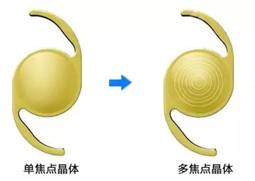 人工晶体单焦双焦三焦有什么区别，各有特点适用于不同需求的患者！